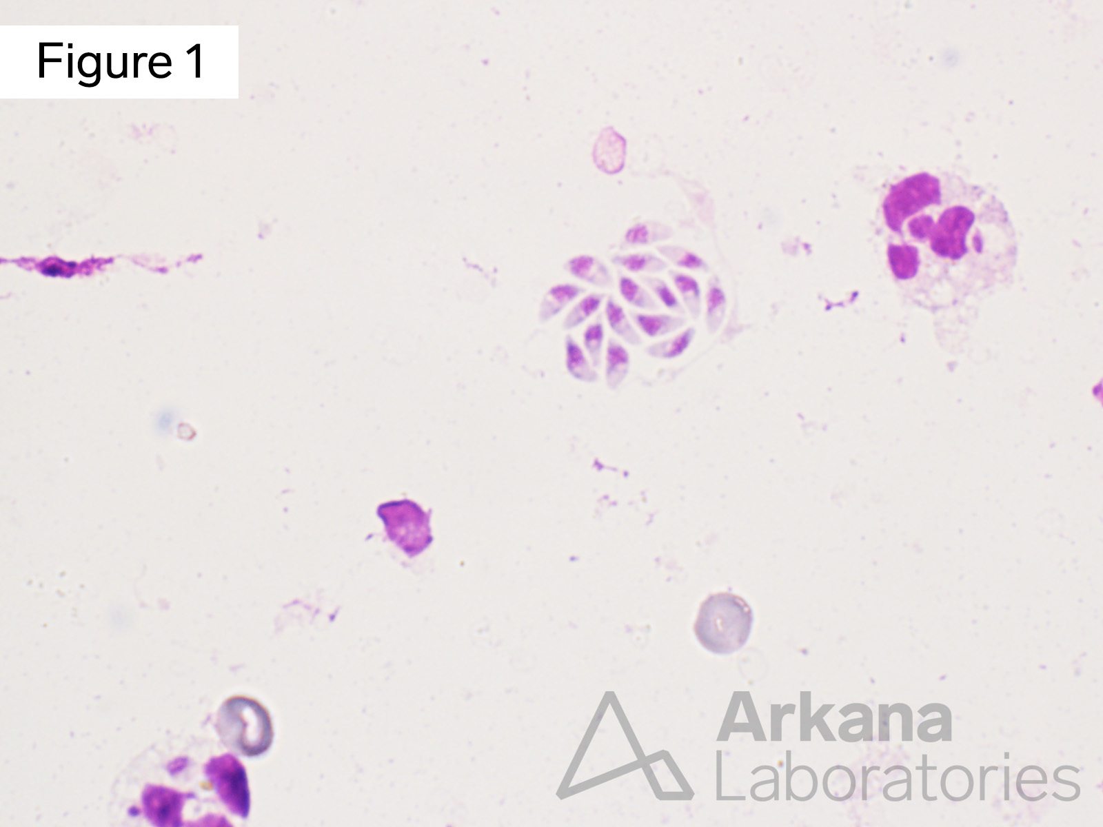 Diff Quik stain showing T. Gondii organism