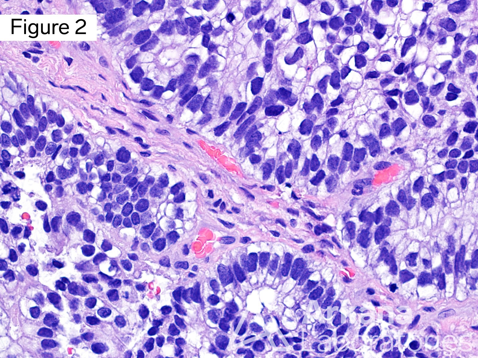 ADENOCARCINOMA, FETAL LUNG, METASTASIS, SUBNUCLEAR