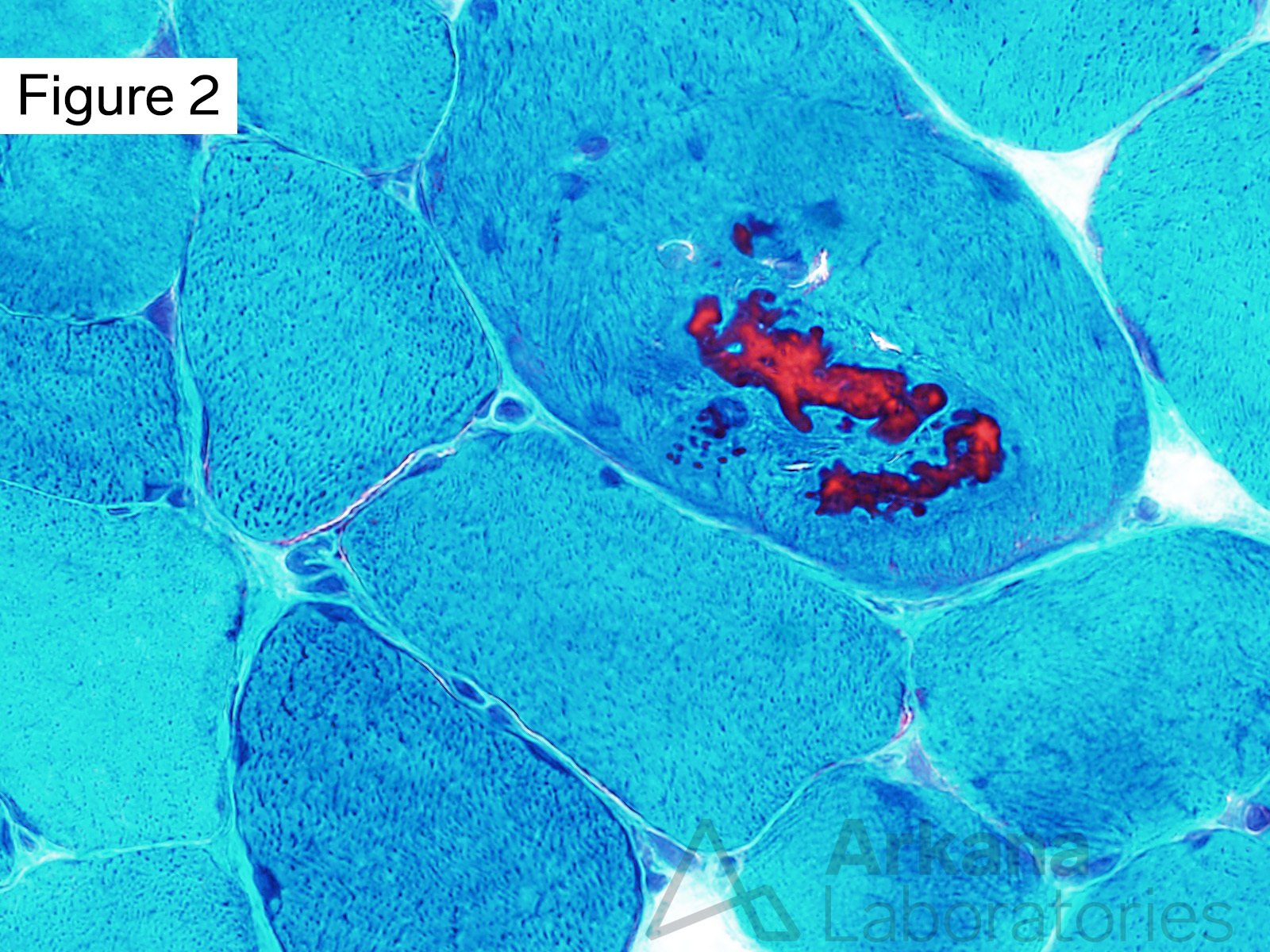 Toxic Myopathy Due to Ingestion of Palytoxin, High magnification image showing a necrotic muscle fiber with an area of sarcomeric (myofibrillar) disorganization