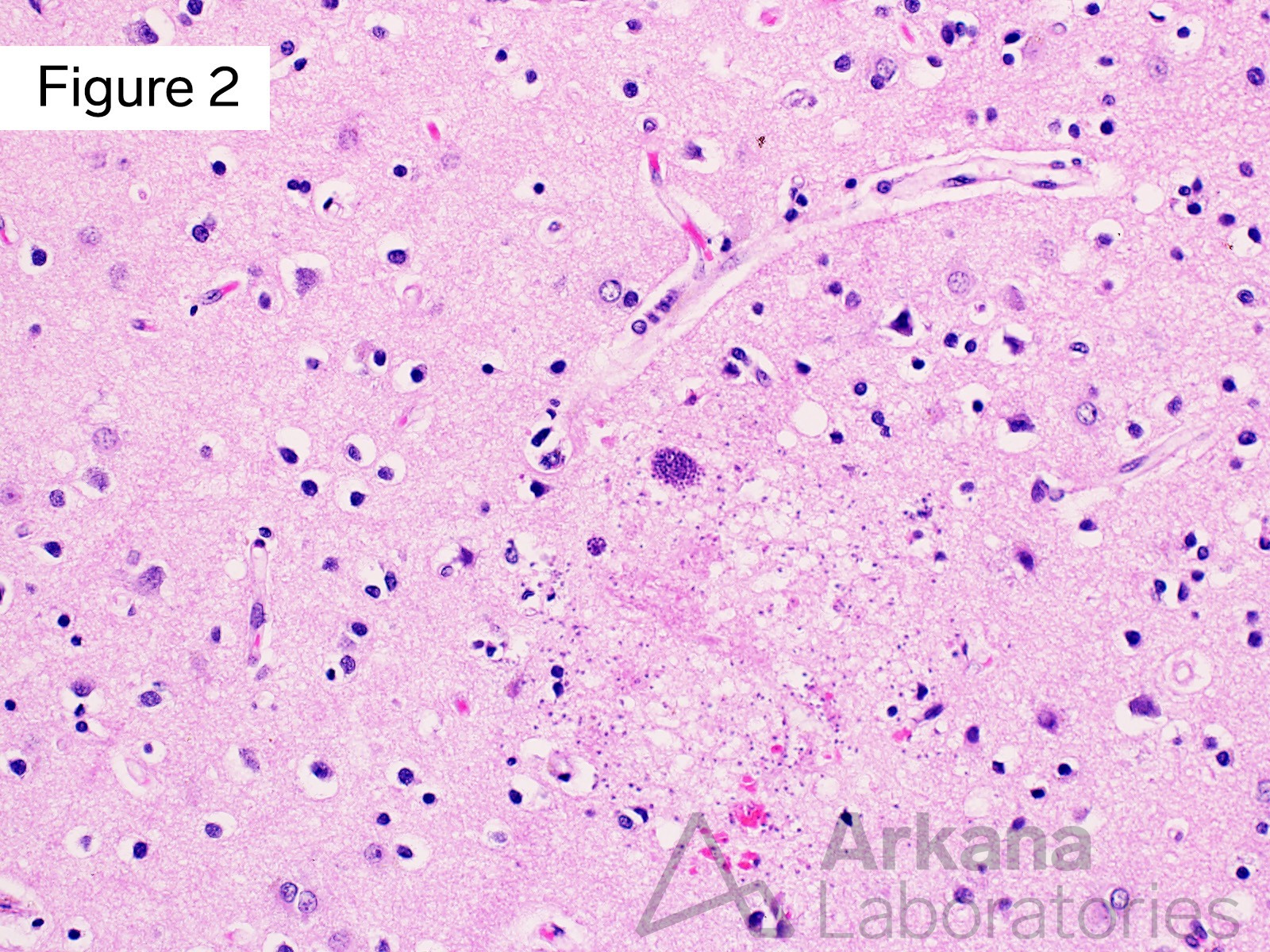 h&E stain showing Toxoplasmosis