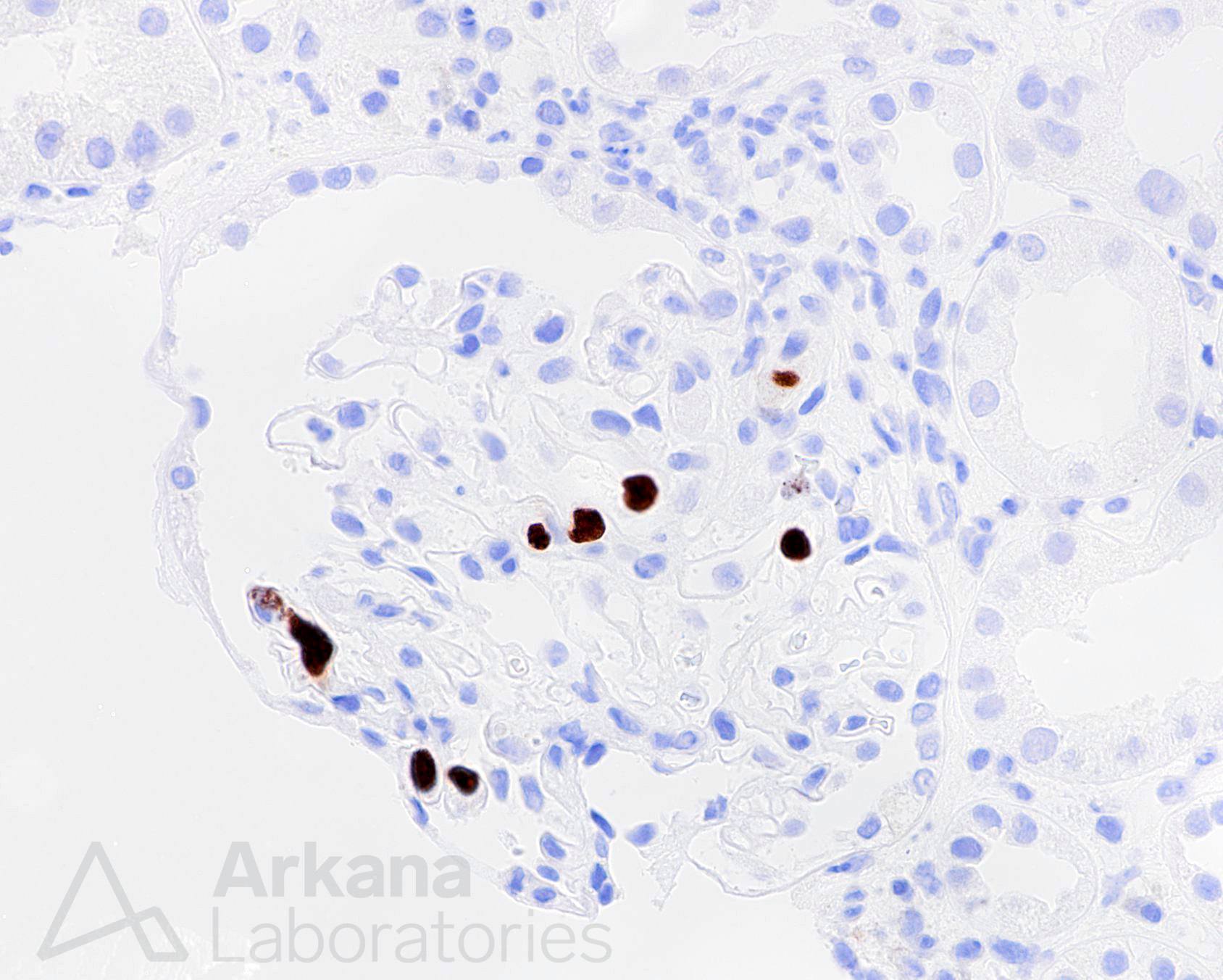 cmv pneumonia