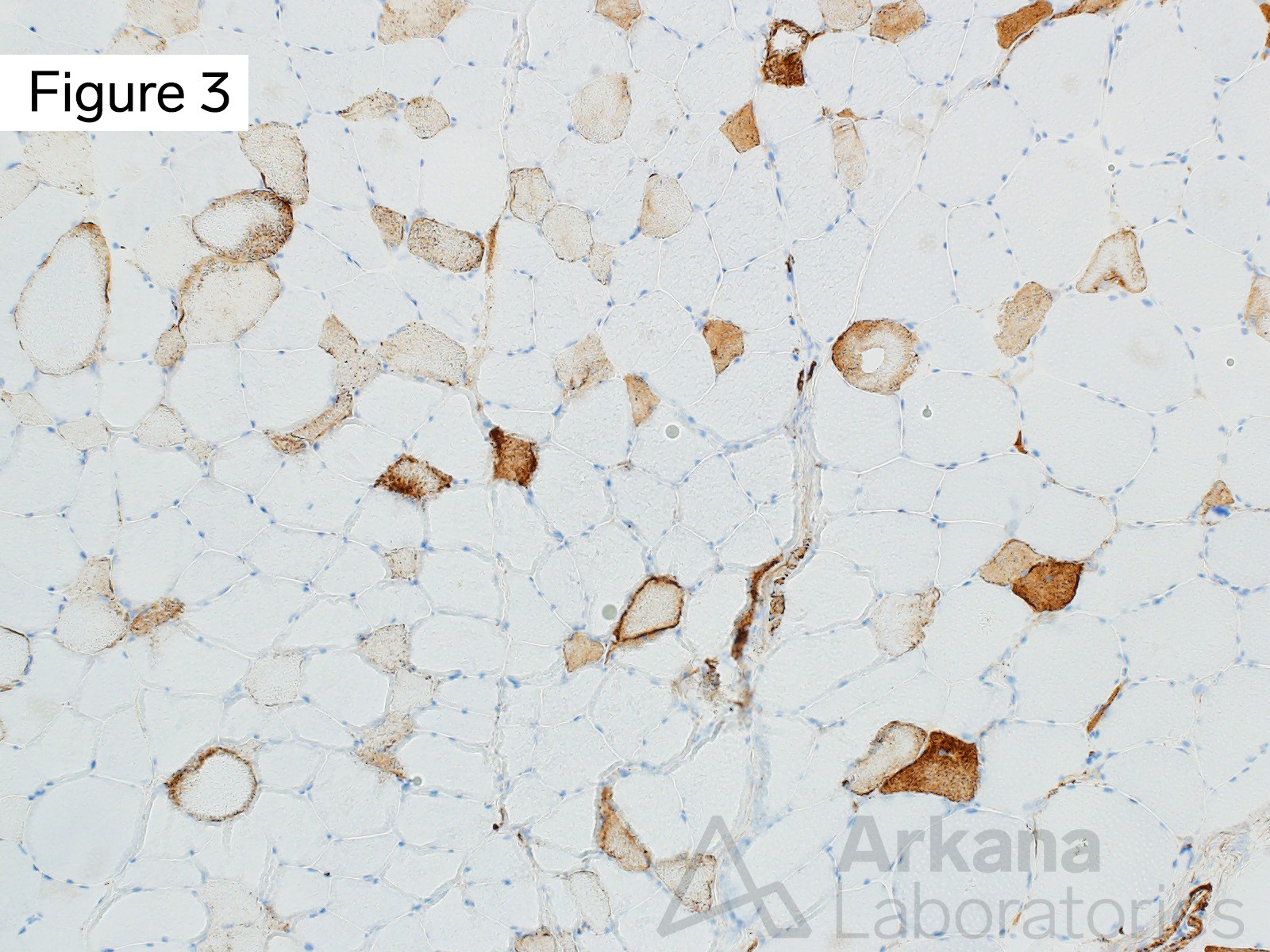 Toxic Myopathy Due to Ingestion of Palytoxin, frequent scattered necrotic muscle fibers