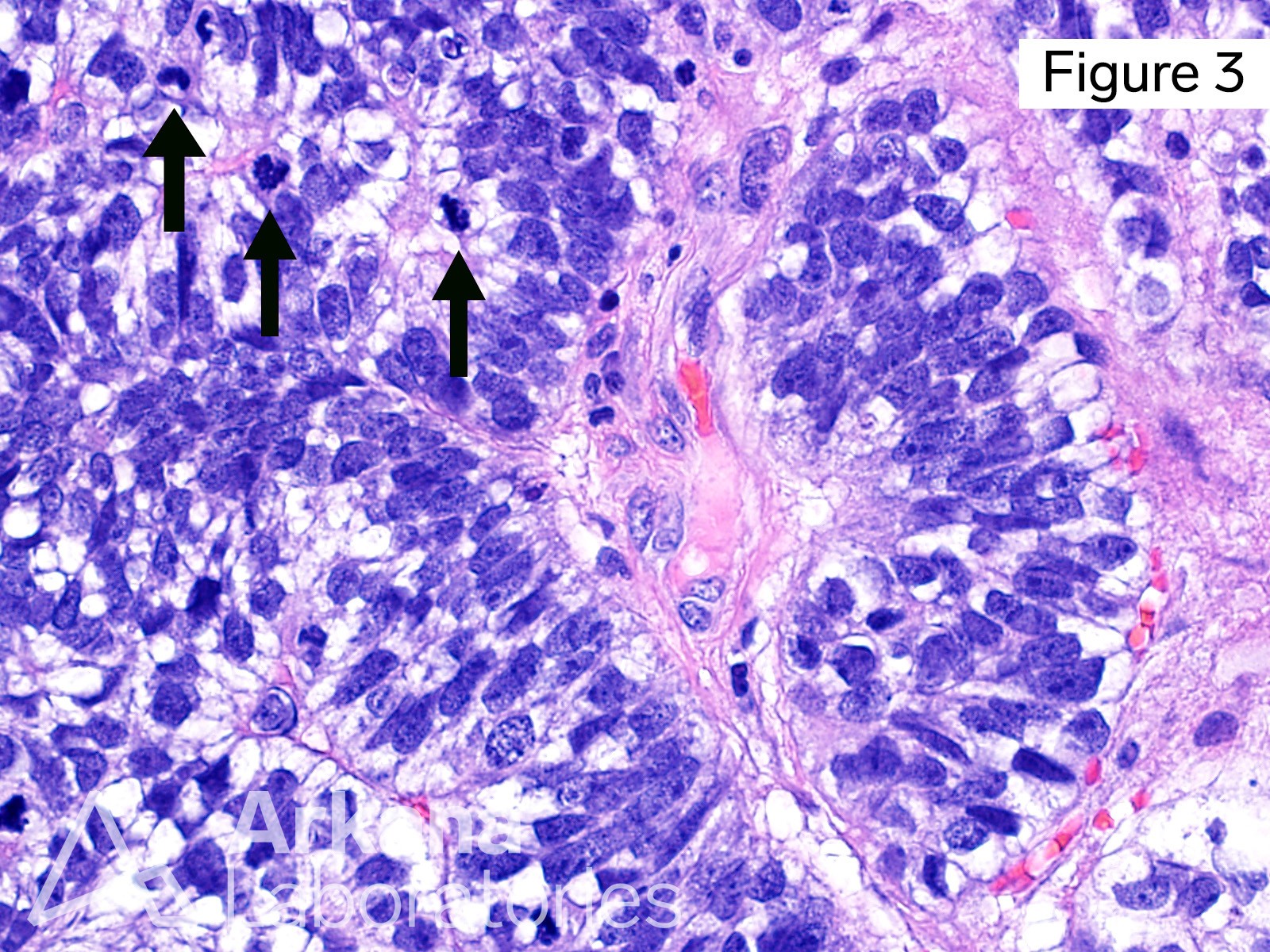 ADENOCARCINOMA, FETAL LUNG, METASTASIS, SUBNUCLEAR