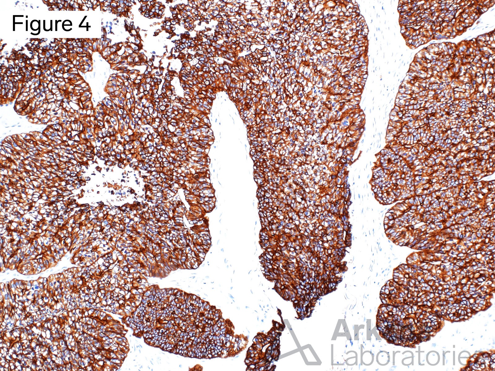 ADENOCARCINOMA, FETAL LUNG, METASTASIS, SUBNUCLEAR