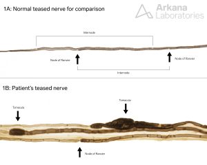 teased nerve preparation showing two figures of normal nerve versus a nerve with Tomacula 