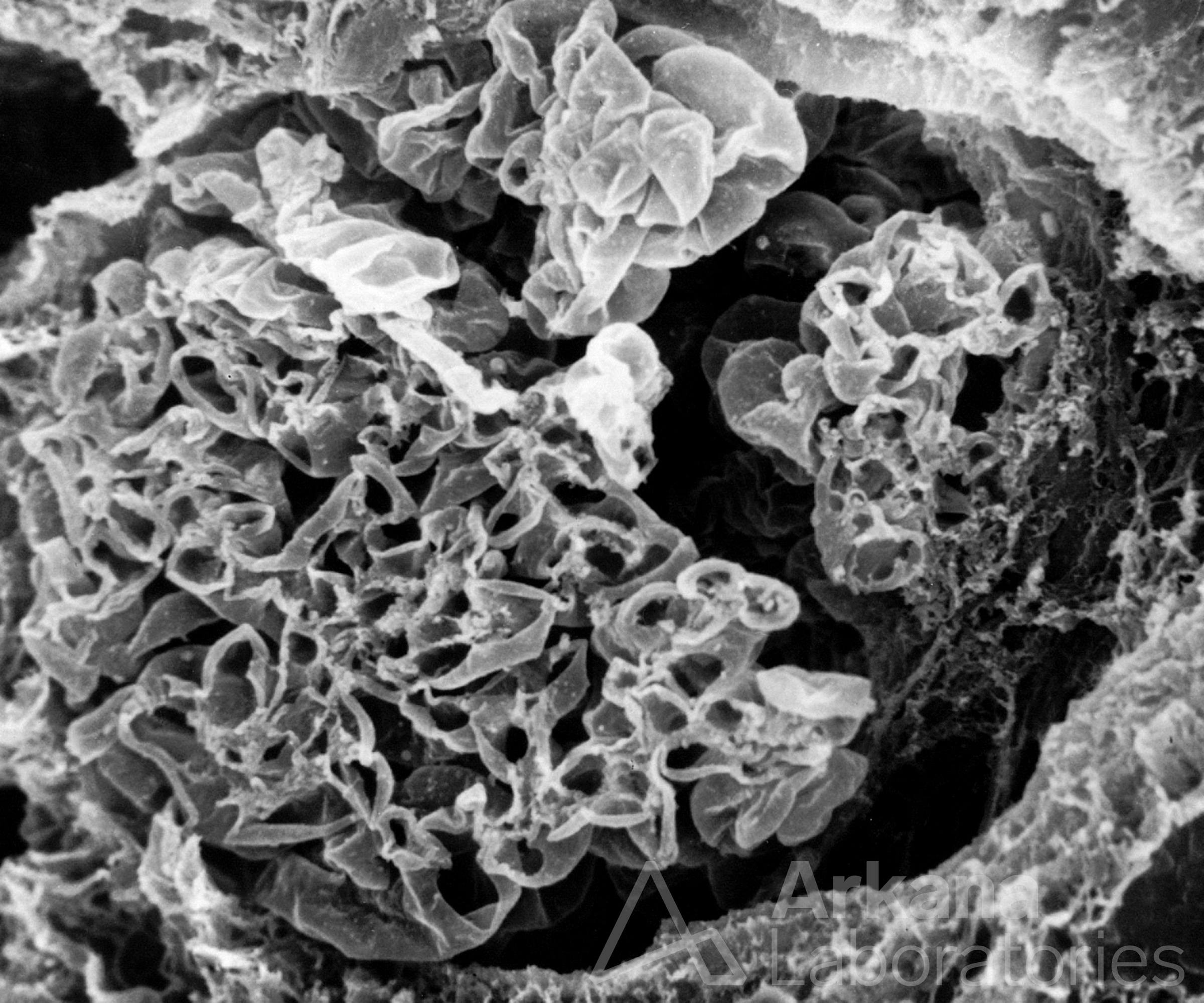 acellular scanning EM image of Glomerulus with Fibrocellular Crescent
