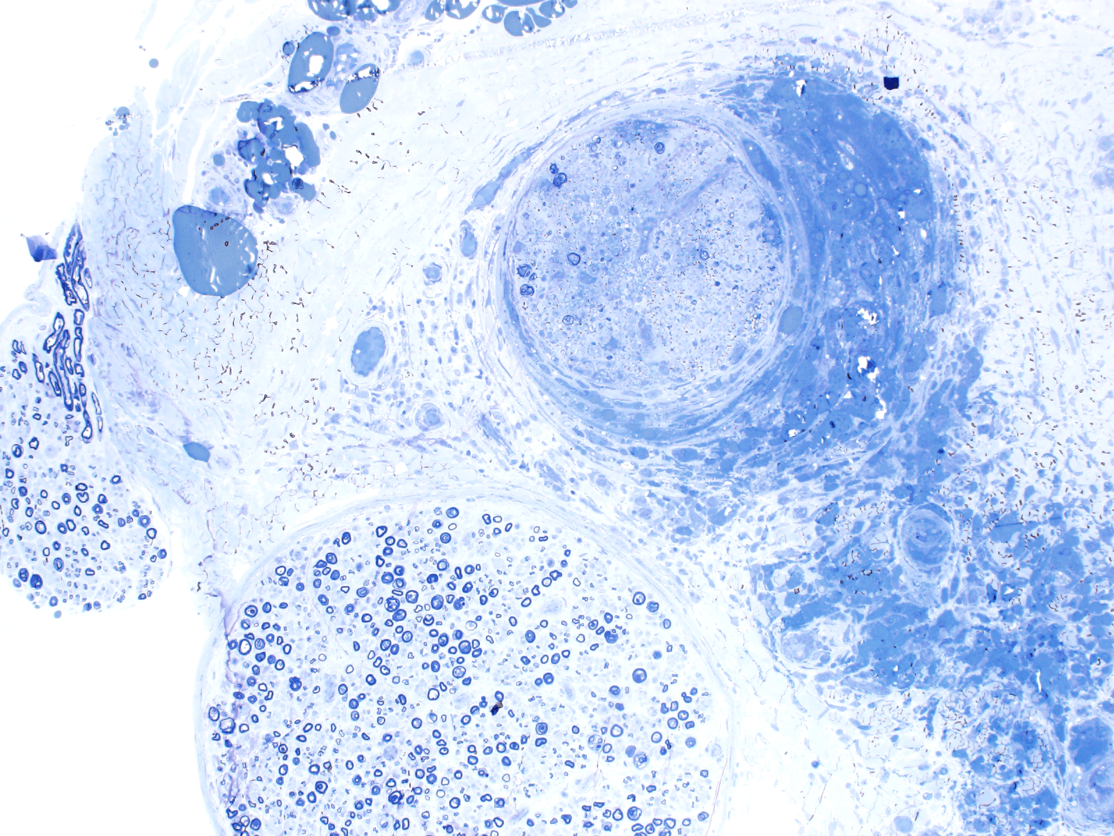 neuropathology image of a muscle biopsy on blue stain