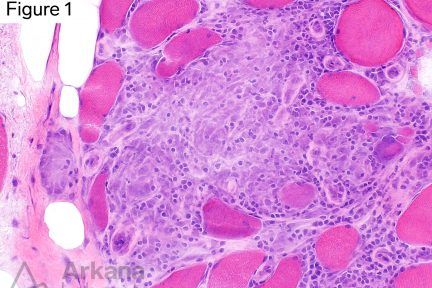 focal relatively circumscribed collection of mononuclear histiocytes with admixed chronic lymphoid inflammation