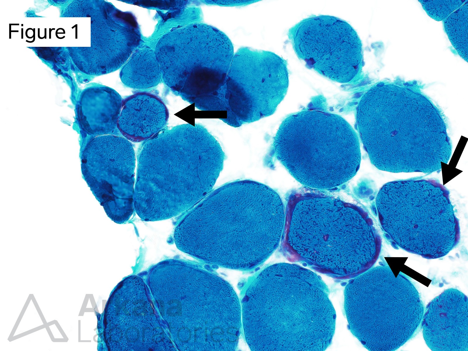 Three muscle fibers (see arrows) show increased subsarcolemmal and intermyofibrillar dark magenta colored granular material