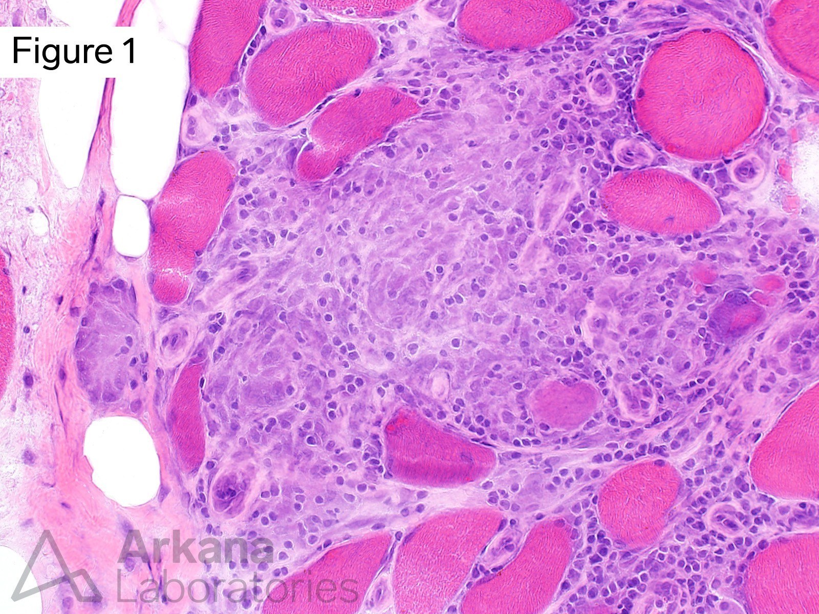 focal relatively circumscribed collection of mononuclear histiocytes with admixed chronic lymphoid inflammation