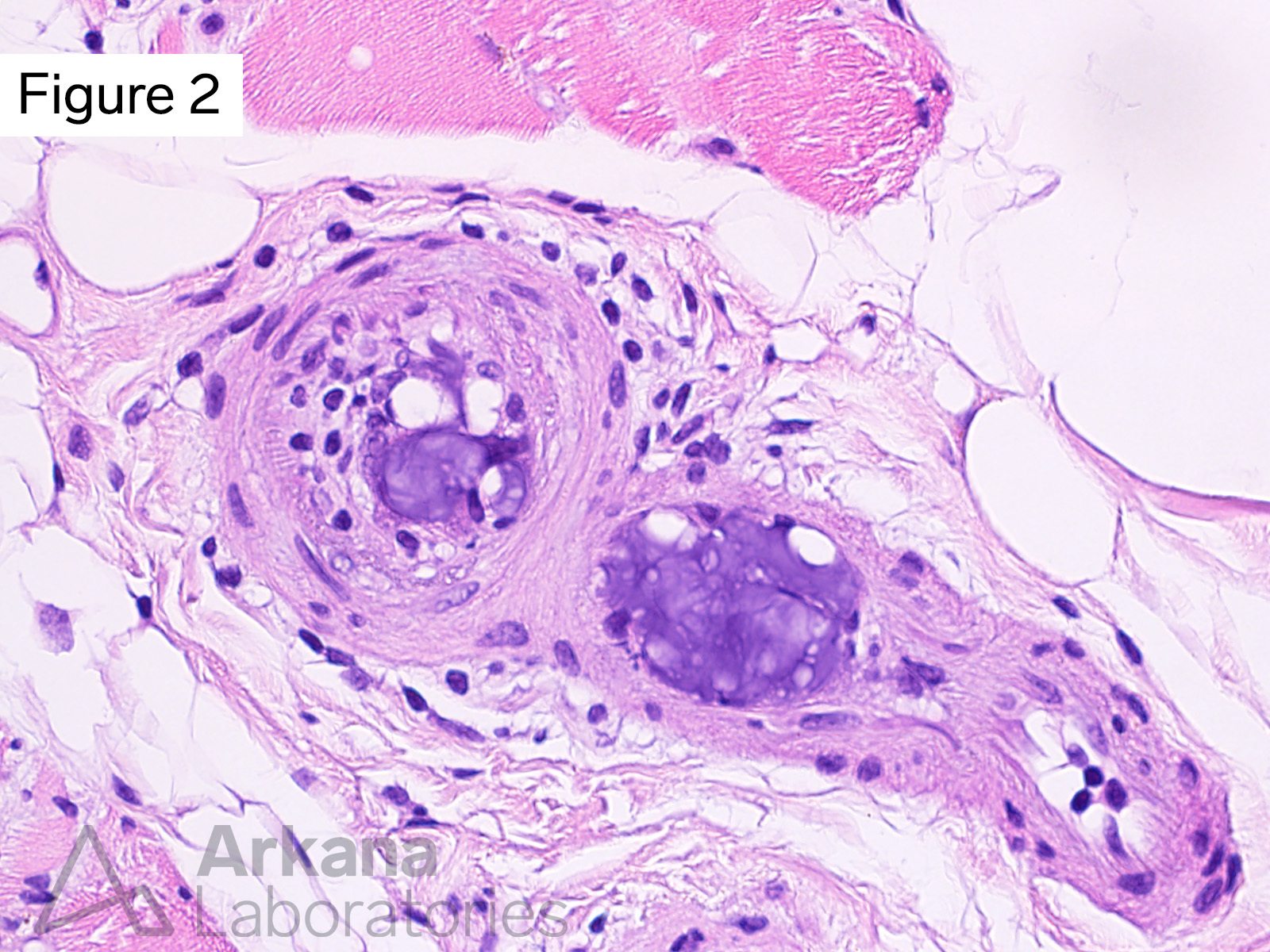 intravascular material is essentially acellular and has an amorphous fairly homogeneous appearance