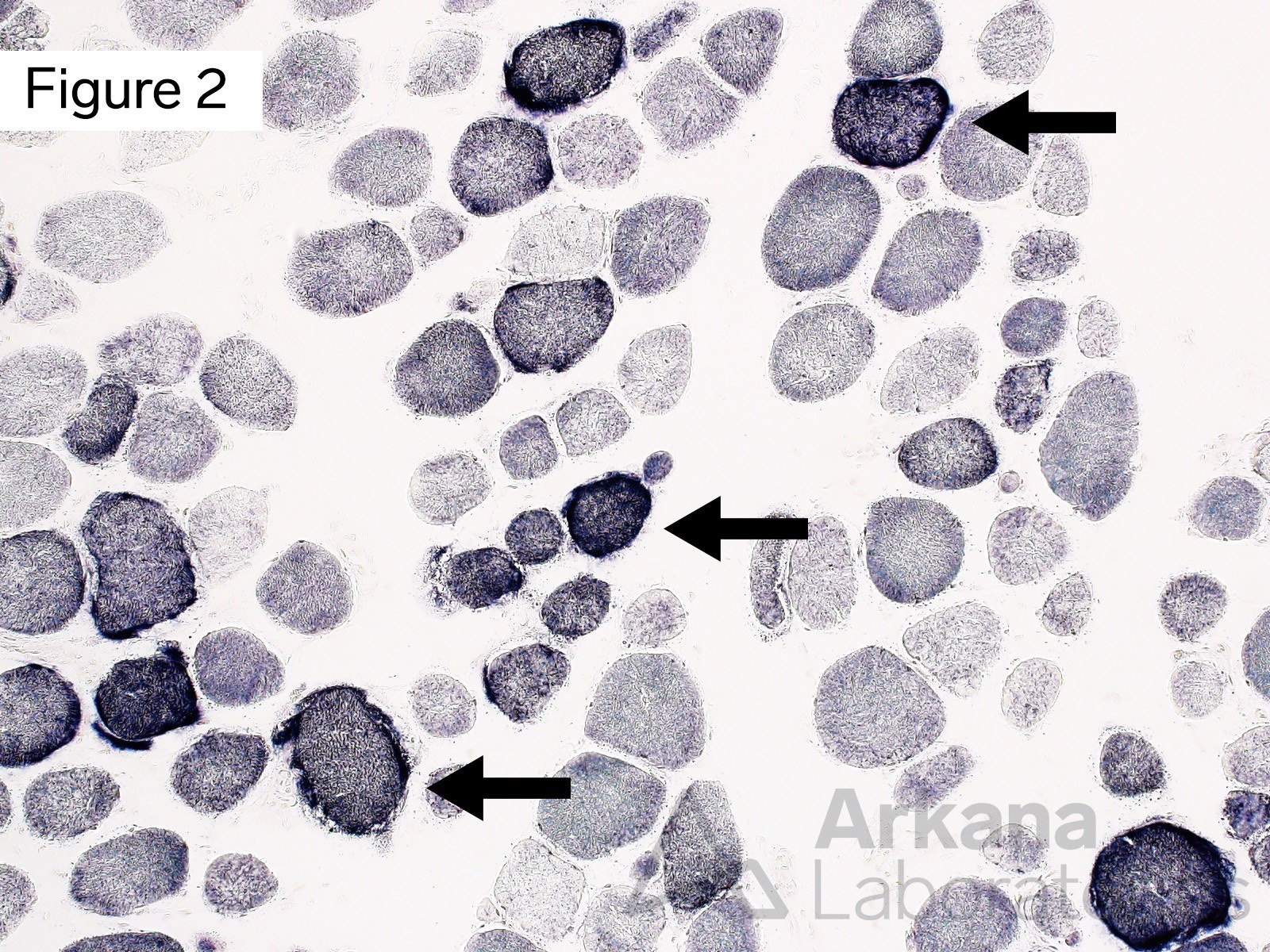 Multiple muscle fibers showing increased staining for succinic acid dehydrogenase