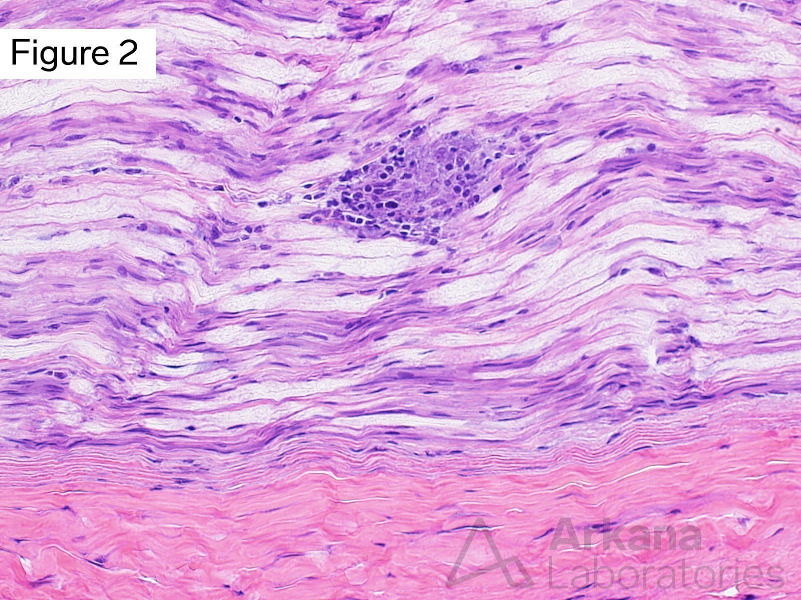 single small focal collection of mononuclear histiocytes with admixed chronic lymphoid inflammation within a nerve fascicle