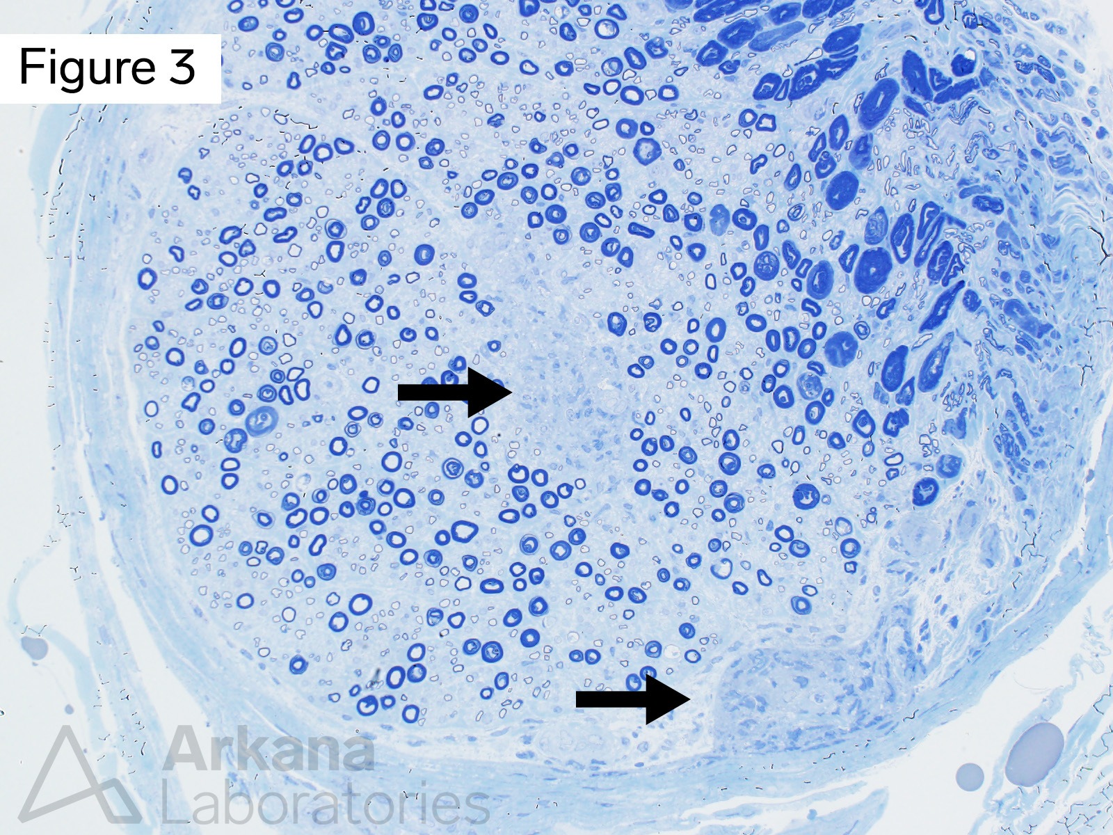 two small relatively circumscribed collections of mononuclear cells within the endoneurium