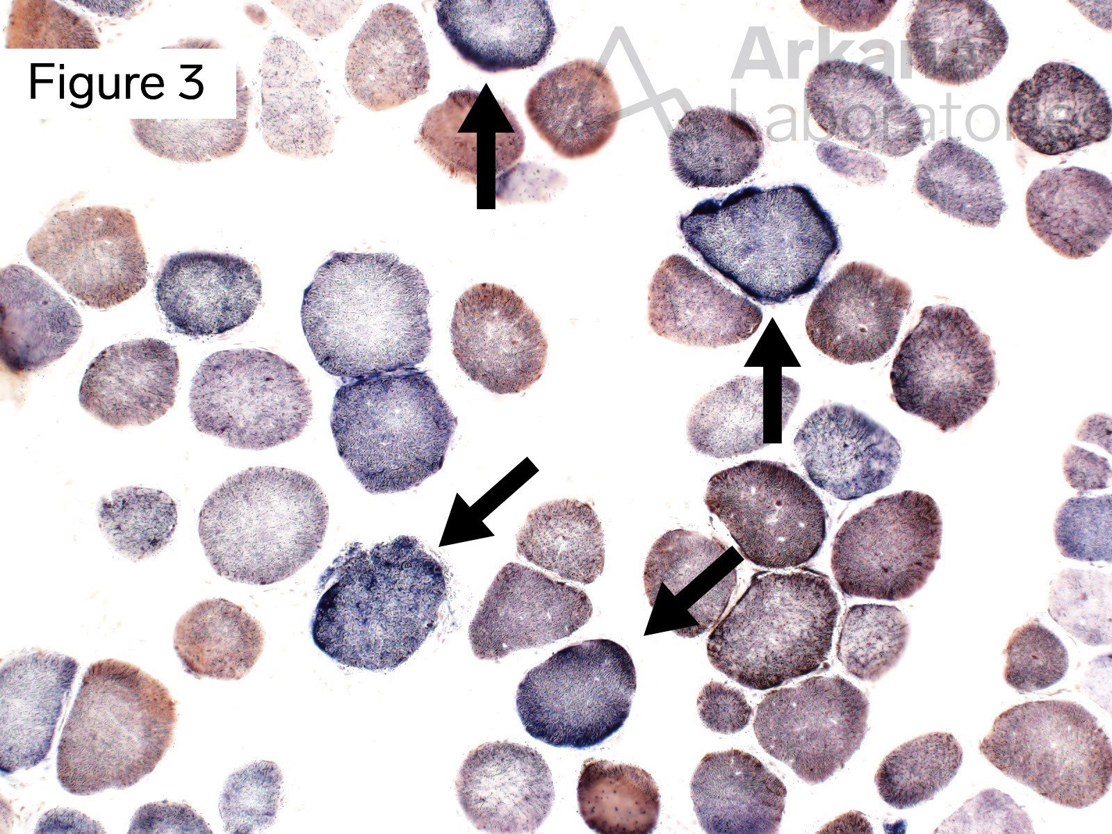 Muscle fibers with intact enzyme histochemical staining for cytochrome oxidase