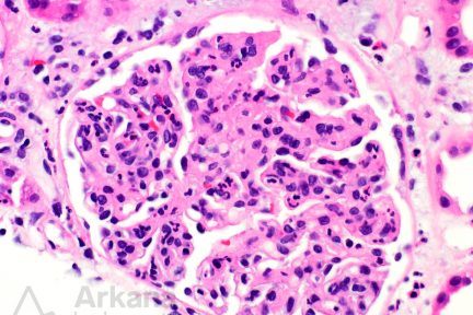 Endocapillary Hypercellularity B