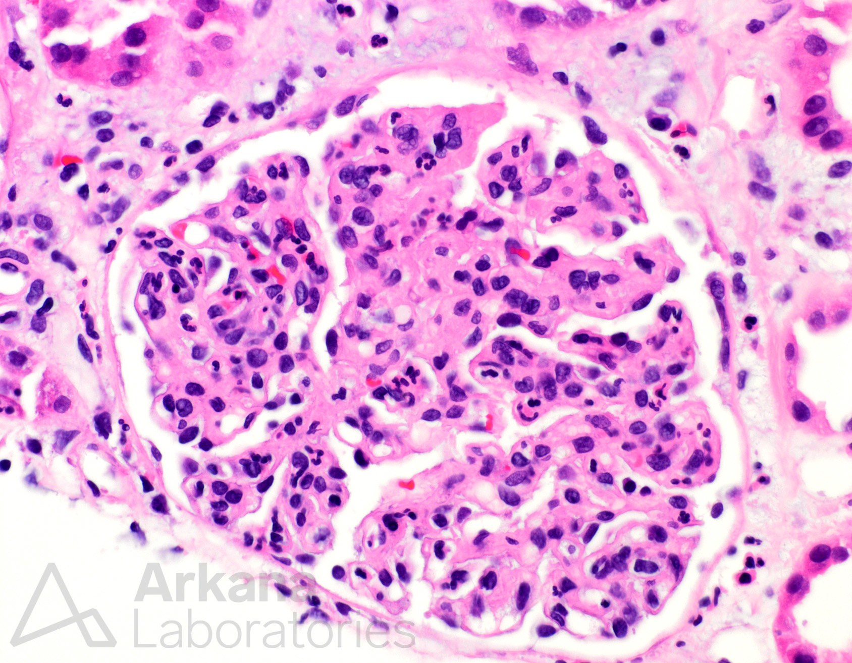 Endocapillary Hypercellularity B