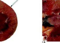 image of kidney biopsy from the paper "The Renal Biopsy"