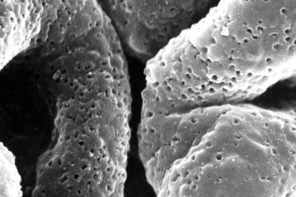 membranous glomerulonephritis