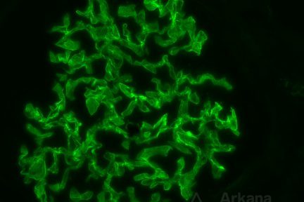 Membranous Nephropathy