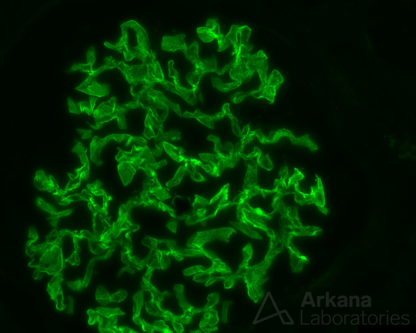 Membranous Nephropathy