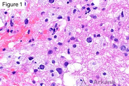 demyelinating lesion and oligodendrocytes with intranuclear viral cytopathic change