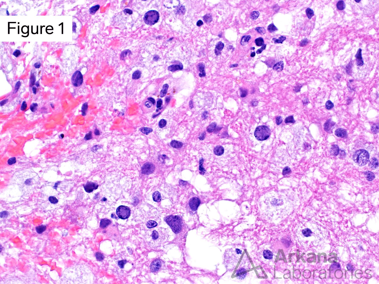demyelinating lesion and oligodendrocytes with intranuclear viral cytopathic change