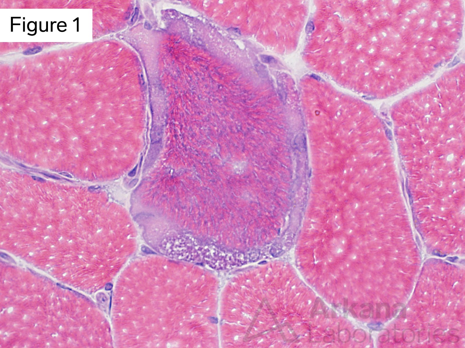 The muscle fiber in center of this images shows increased finely granular to smudgy material between the sarcomeres and beneath the sarcolemma