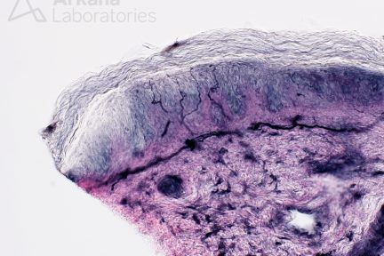 nerve fibers in skin biopsy