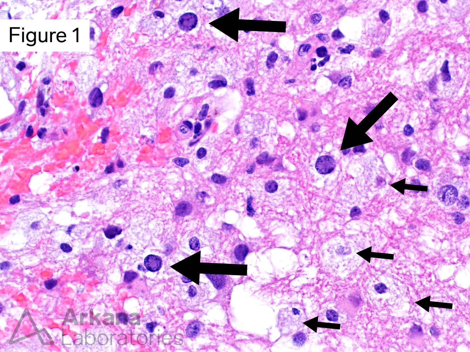 demyelinating lesion and oligodendrocytes with intranuclear viral cytopathic change on h&E stain