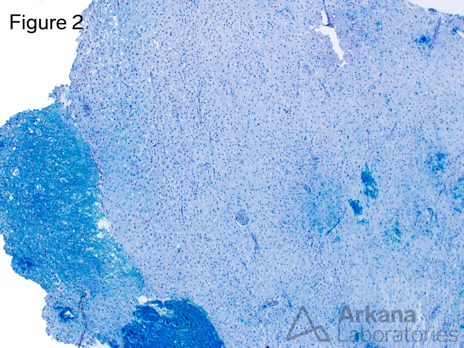 This low power image of a Luxol-Fast-Blue histochemical preparation (myelin stain) shows areas of white matter with preserved blue-staining myelin