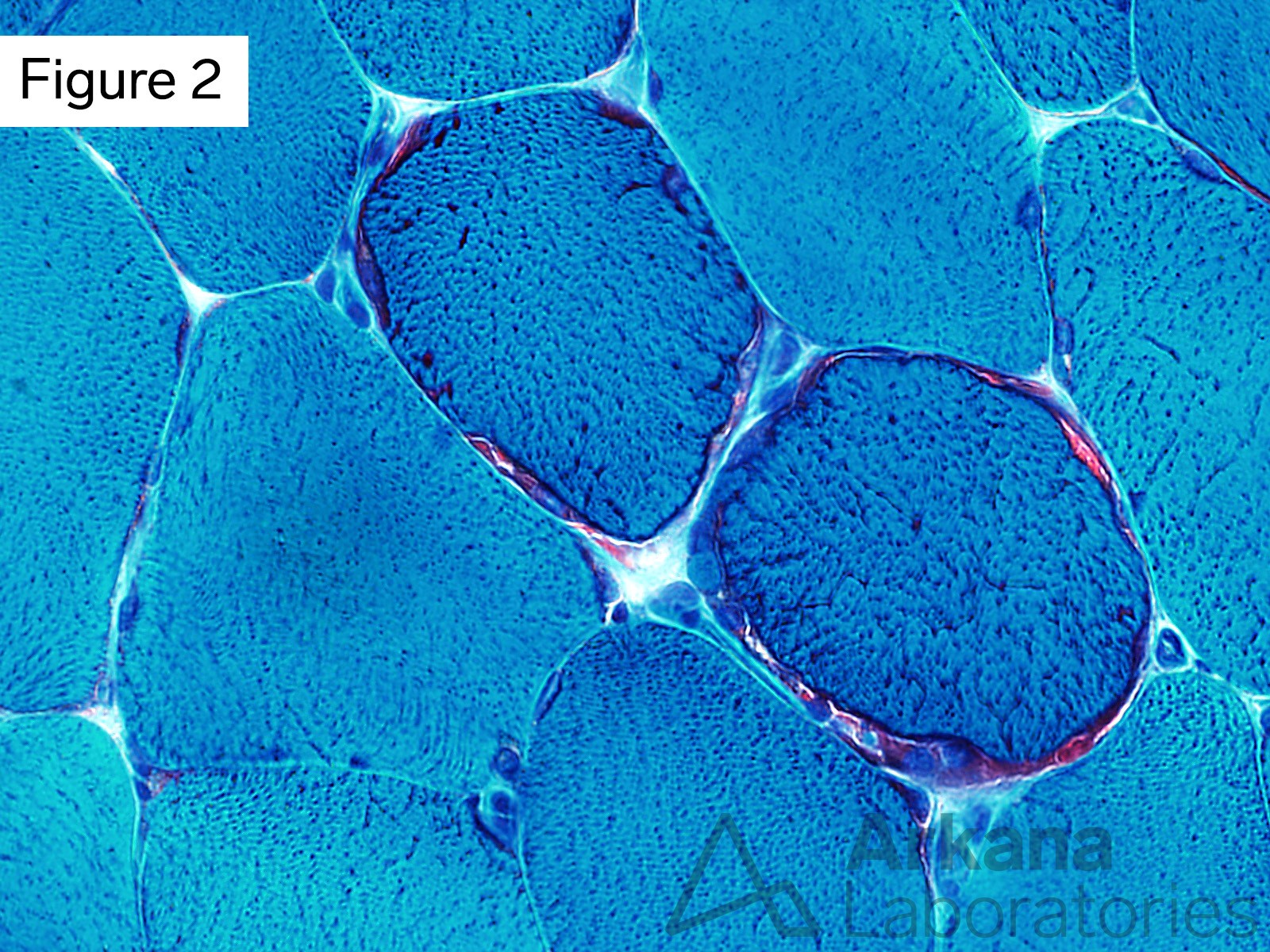 modified Gomori Trichrome stain in two other muscle fibers