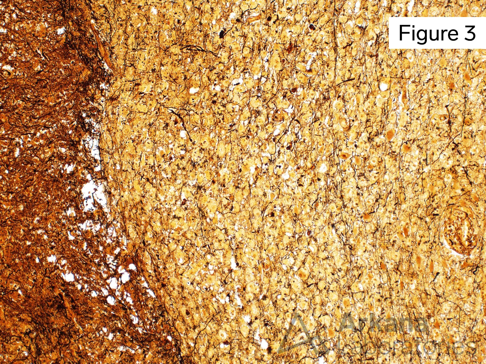 preservation of axons on bielschowsky silver stain