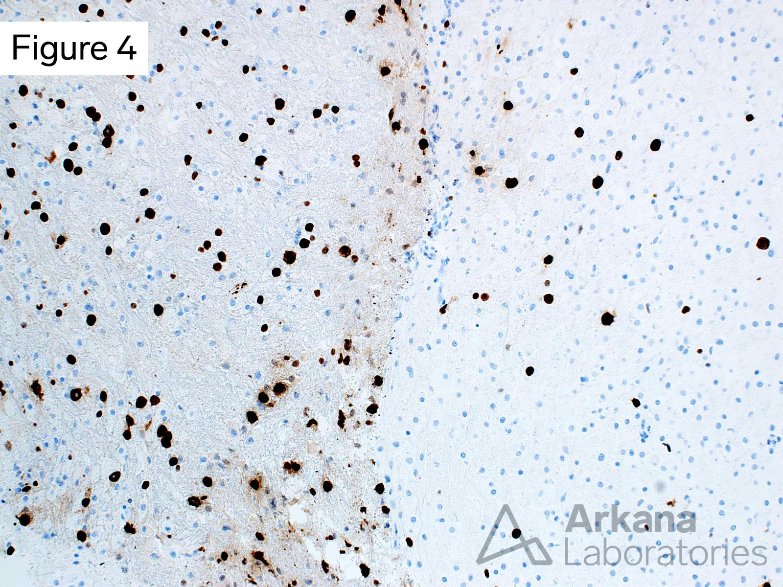 KI67 IHC stian showing proliferative activity