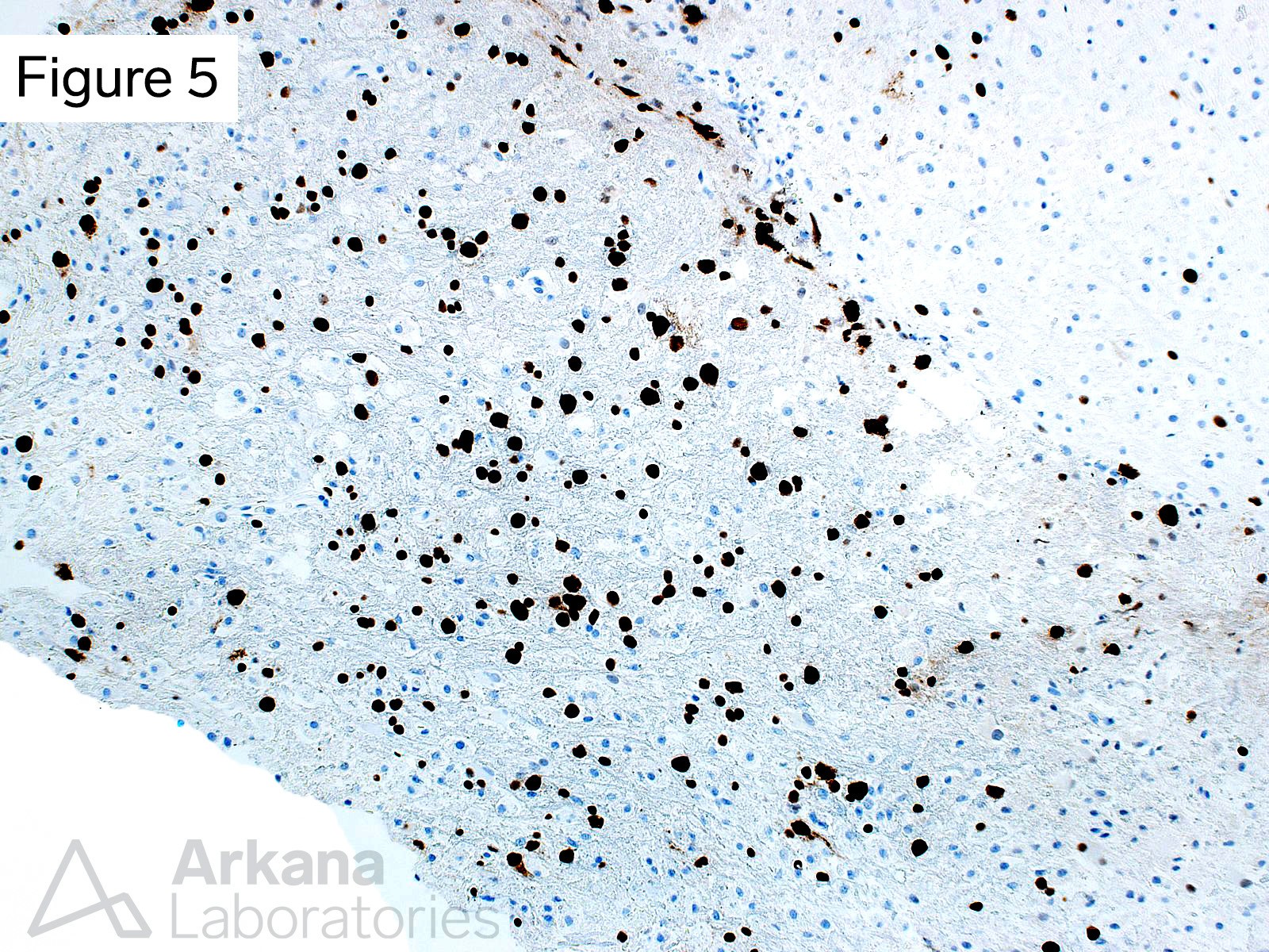 The immunohistochemical stain for polyomavirus highlights the nuclei