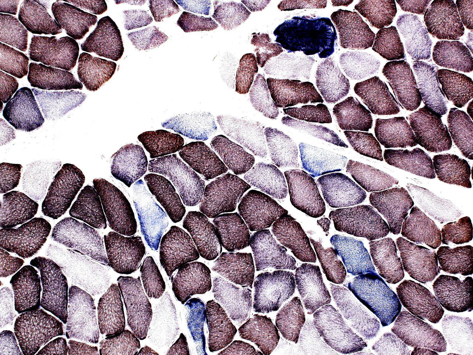 combined COX/SDH stained frozen section 100x original magnification