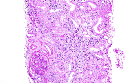 Borderline T-Cell Mediated Rejection