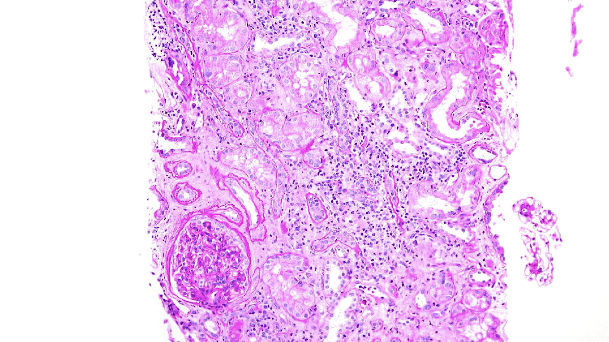 Borderline T-Cell Mediated Rejection