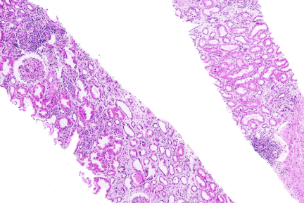 Acute T-Cell Mediated Rejection