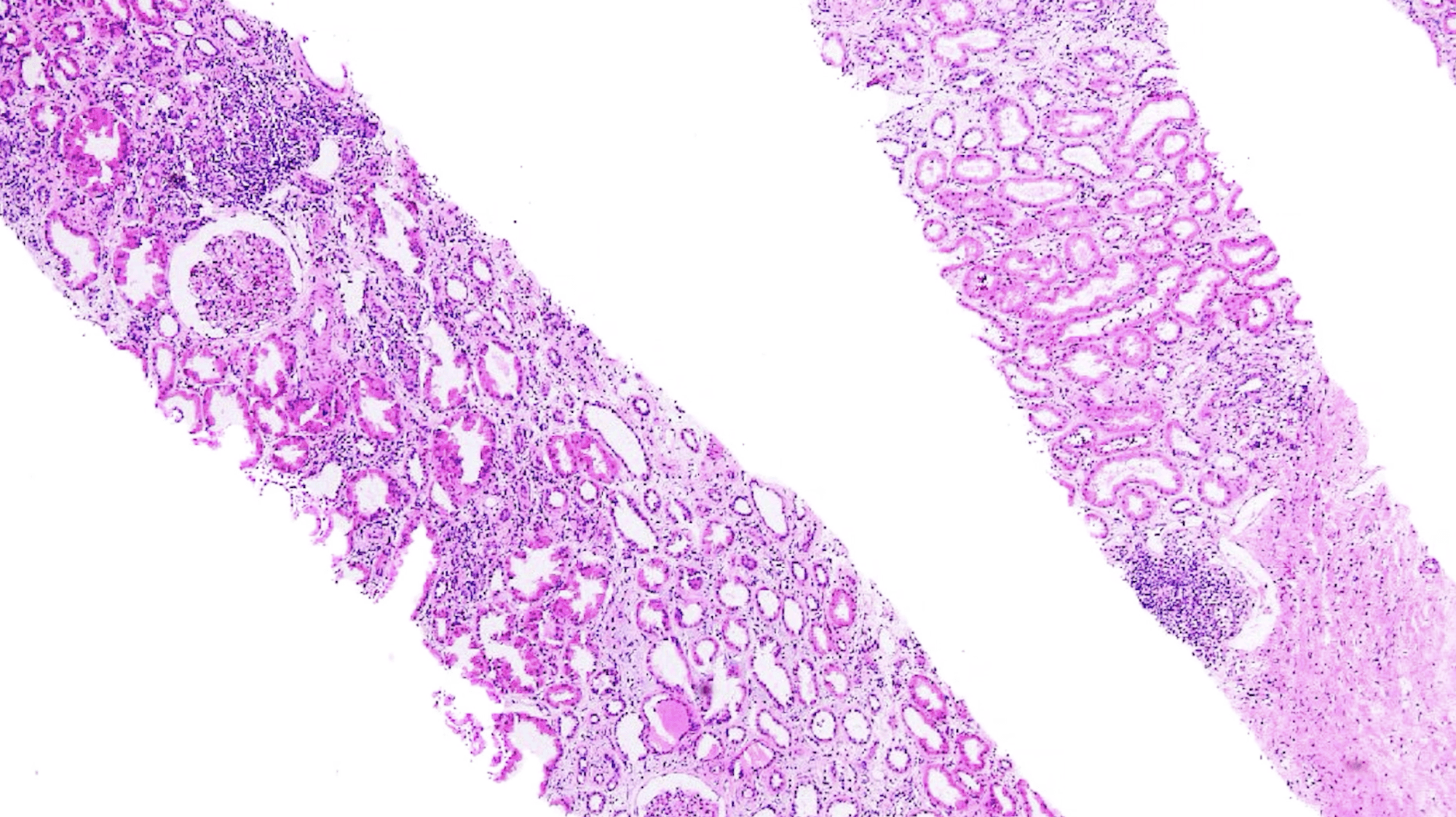 Acute T-Cell Mediated Rejection