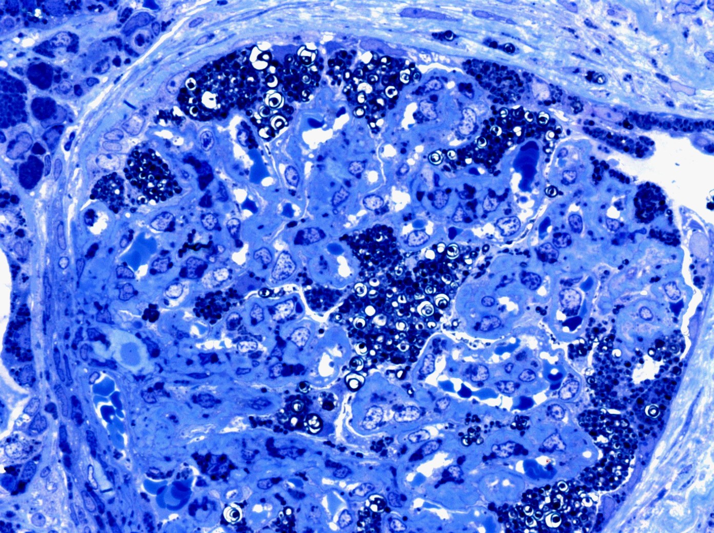toluidine blue section showing fabry disease