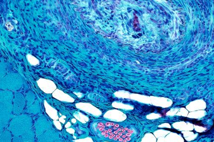 vasculitis (“vasculitic myopathy”)