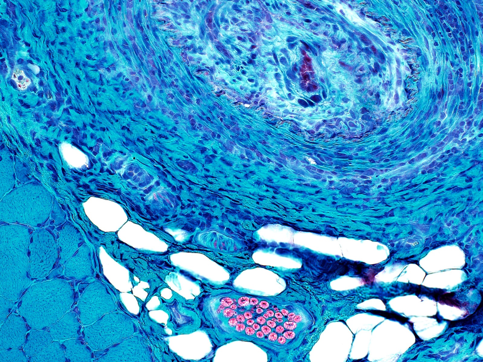 vasculitis (“vasculitic myopathy”)