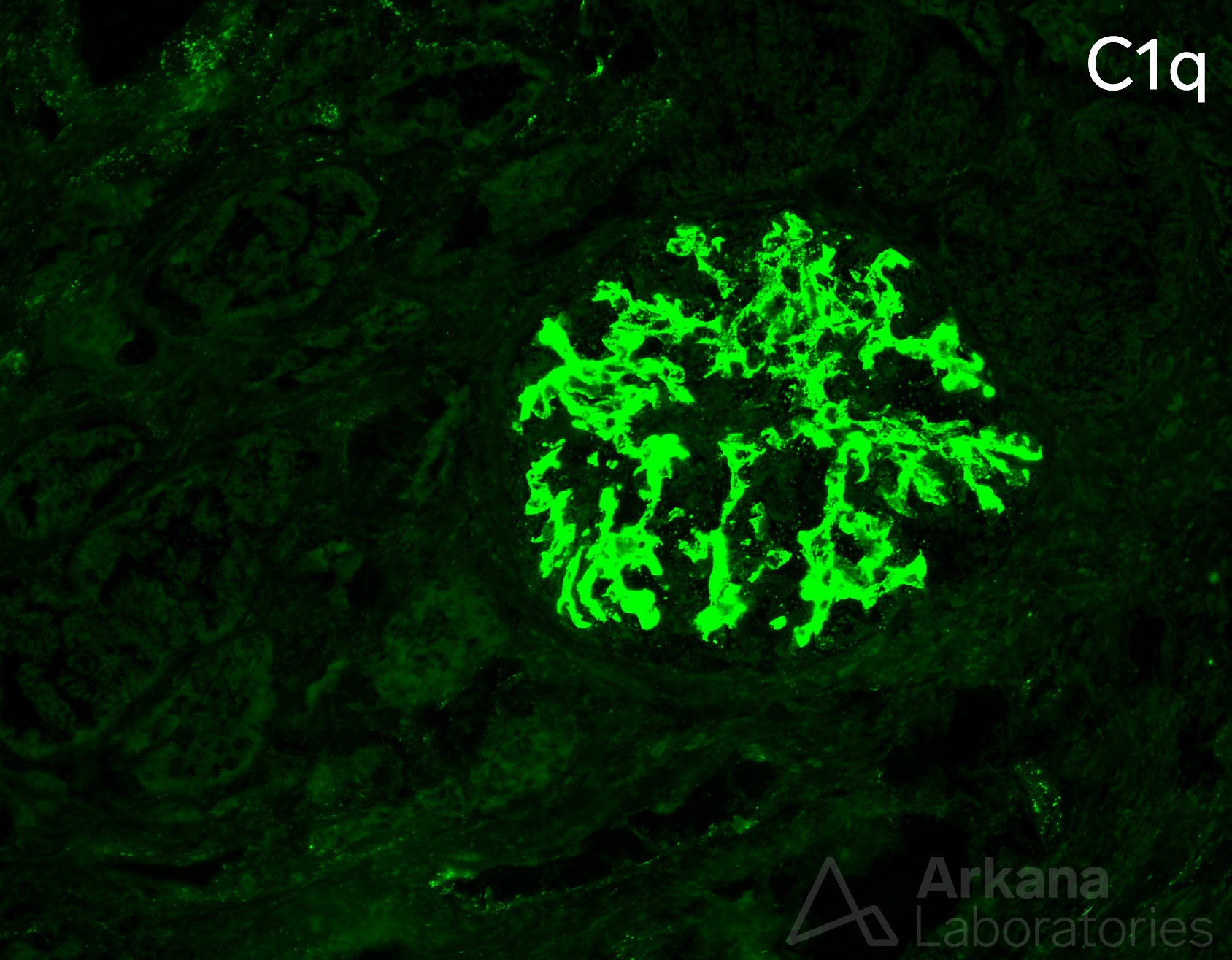 class IV lupus nephritis