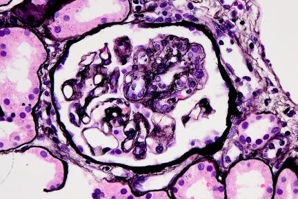 Chronic Active Antibody Mediated Rejection