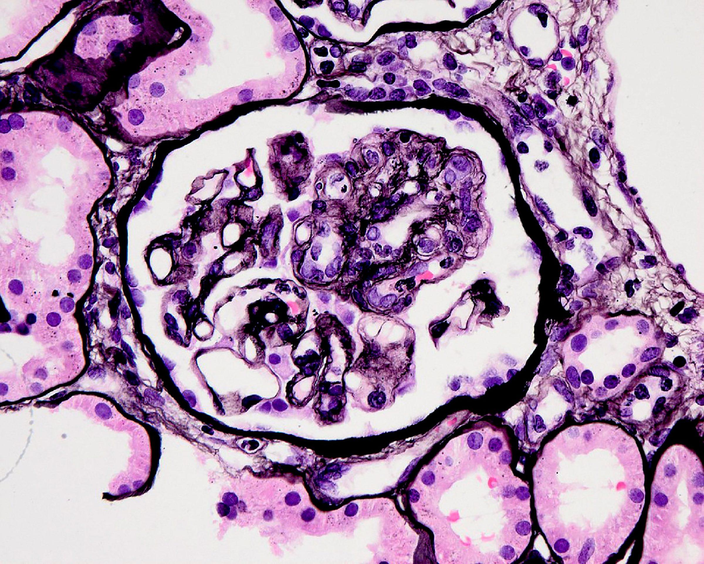 Chronic Active Antibody Mediated Rejection