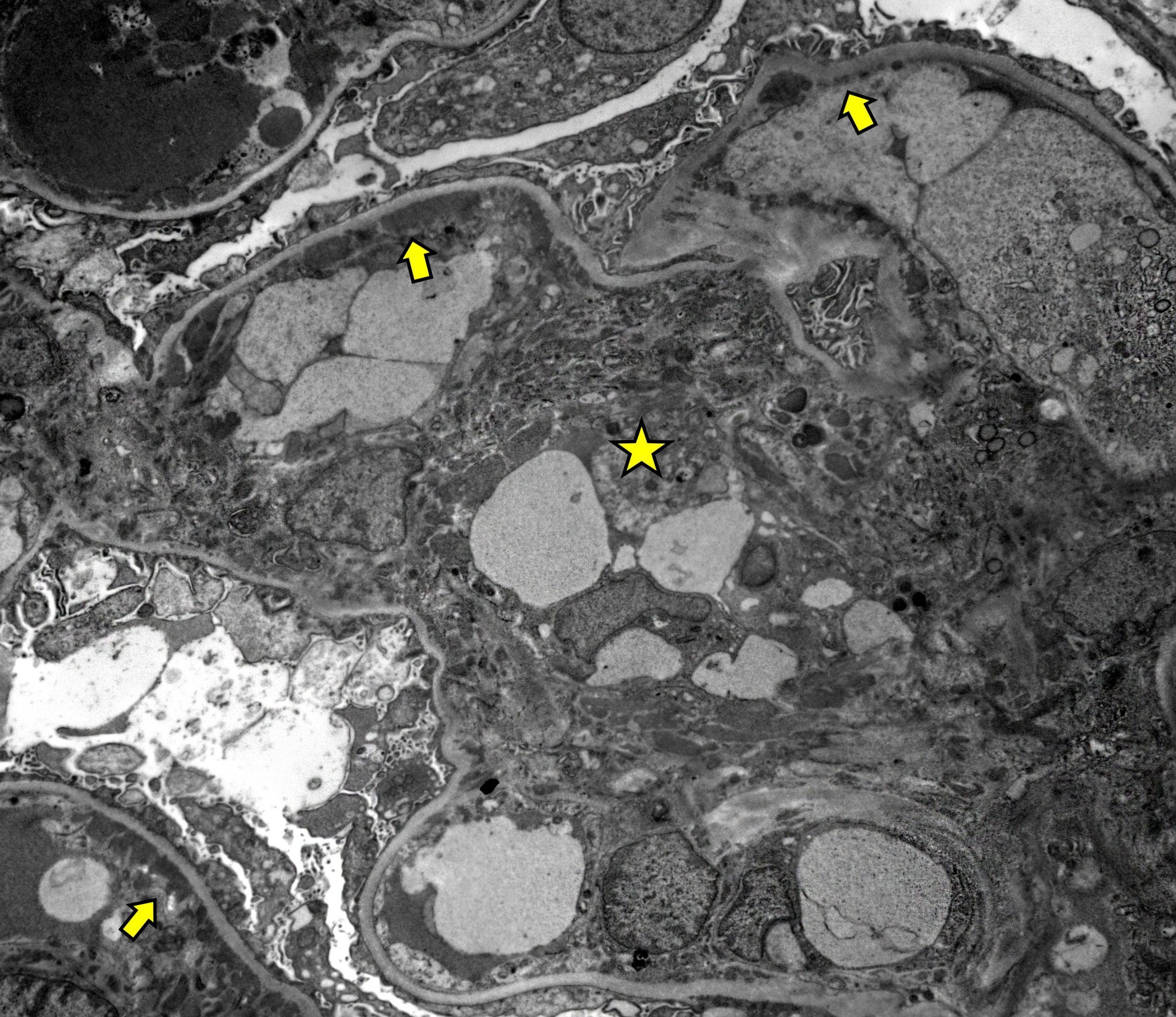 numerous mesangial and subendothelial electron dense deposits