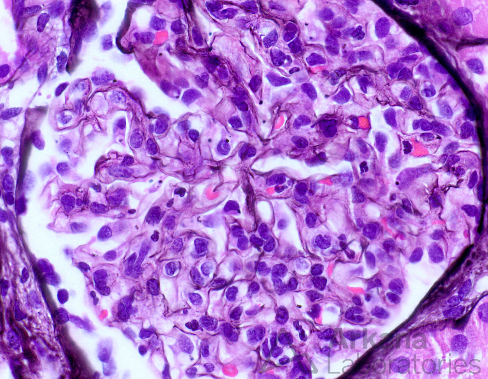 class IV lupus nephritis