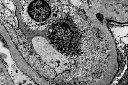 chronic antibody mediated rejection, peritubular capillary basement membrane multilayering