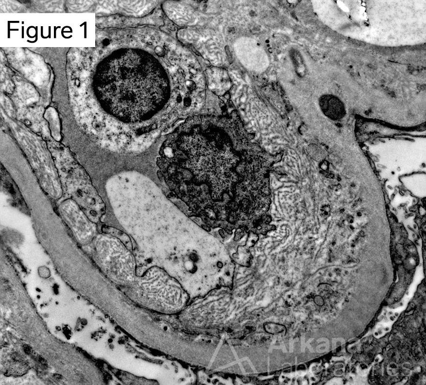 chronic antibody mediated rejection, peritubular capillary basement membrane multilayering